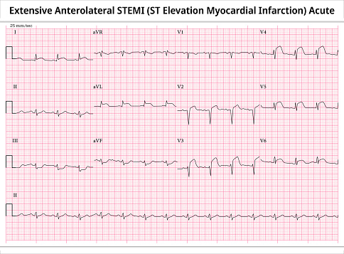 Extensive Anterolateral STEMI (ST-Elevation Myocardial Infarction) Acute - Electrocardiography  Paper 12 Lead - Vector Medical Illustration