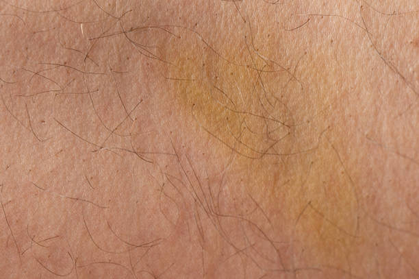 istock Beaten spot on human skin 1464487623