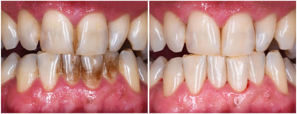 istock teeth tartar and calculus deep cleaning 1464507069