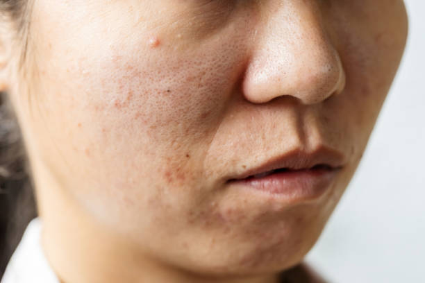 problema di acne sul viso - 2971 foto e immagini stock