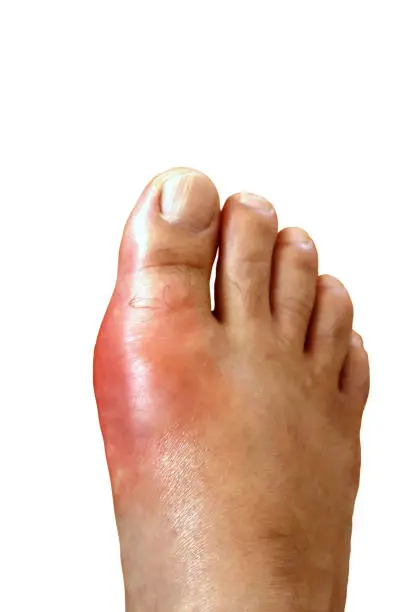 Visible gout inflammation on the foot of a man
