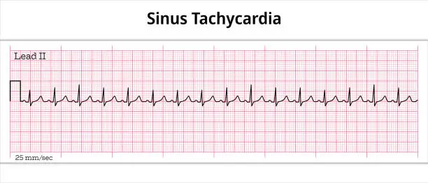 Vector illustration of ECG Sinus Tachycardia - 8 Second Electrocardiography Paper