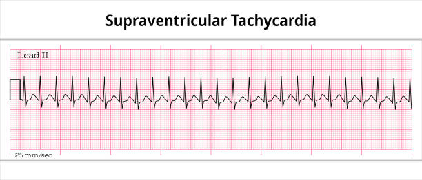 ECG Supraventricular Tachycardia - 8 Second Electrocardiography Paper ECG Supraventricular Tachycardia - 8 Second ECG Paper - Electrocardiography Vector Medical Illustration heart ventricle stock illustrations