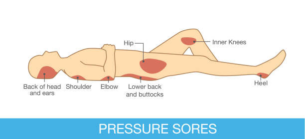 ilustraciones, imágenes clip art, dibujos animados e iconos de stock de área de úlceras por presión en una parte del cuerpo humano. ilustración sobre el dolor causado por la falta de movimiento, como acostarse en la cama sin poder girar por su cuenta. - physical injury