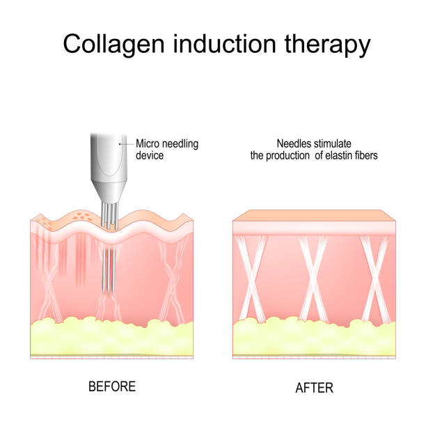 Collagen induction therapy vector art illustration