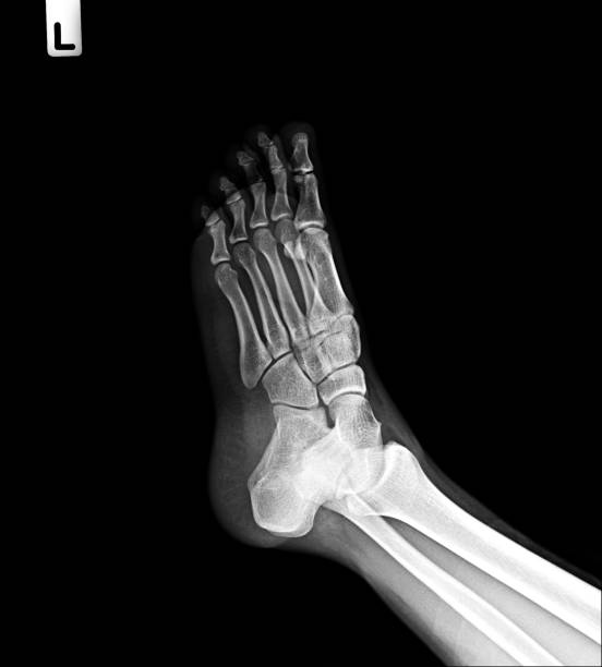 istock Film x-ray both foots oblique. 1465023968