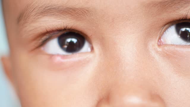 Closeup of Infected child eye patch with painful bump on lower eyelid. eye disease. blinking eyes