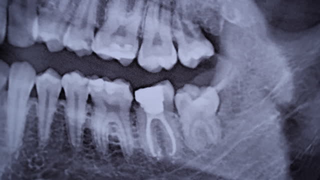 X-ray Image of the Jaw of All Human Teeth Close-up