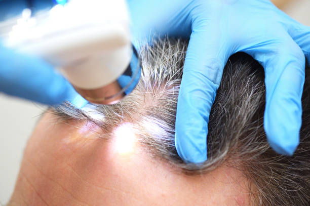 A cosmetologist-trichologist diagnoses the condition of a male patient's hair with gray hair using a trichoscope. stock photo