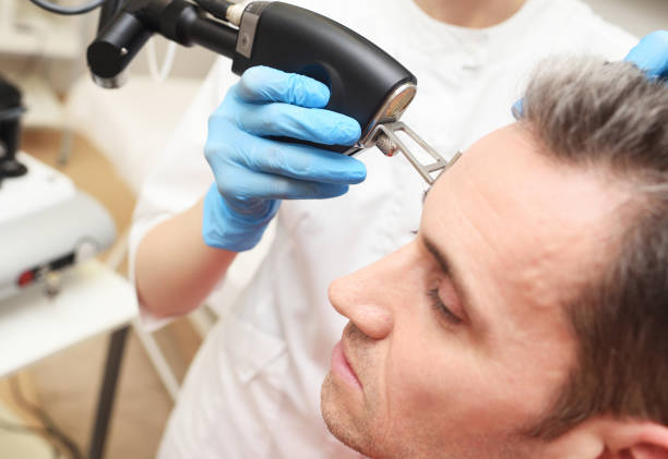 cosmetologist uses a CO2 fractional ablative laser to rejuvenate the skin of the face and remove vascular asterisks from a male patient in a modern cosmetic beauty clinic. stock photo