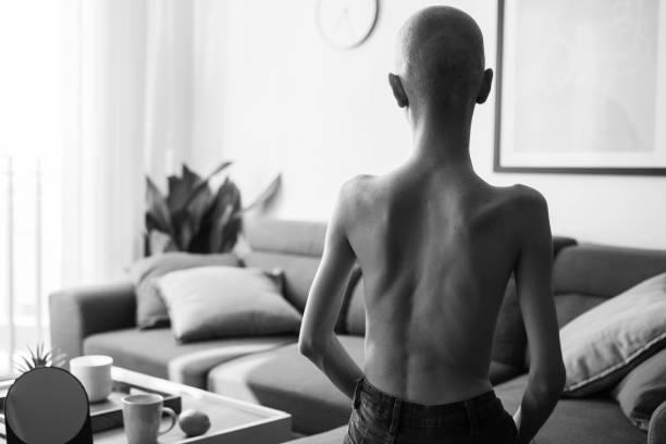 Black and shite shot of young woman fighting with cancer and anorexia. Black and white rear shot of young female fighting with cancer and anorexia. photos of anorexia pictures stock pictures, royalty-free photos & images