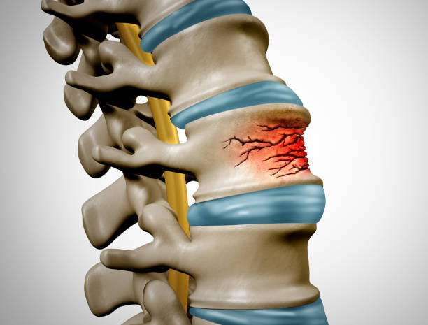 fractura traumática de la columna vertebral - vértebra humana fotografías e imágenes de stock