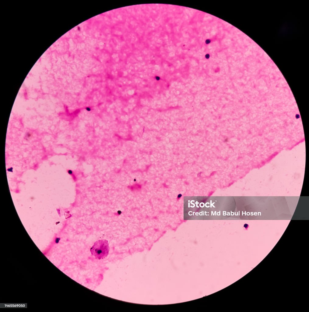Scrotal hydrocele(FNA cytology): microscopic image shows lymphocytes and hostiocytes. background of fluidy material. no malignant cell present. scrotal swelling or testicular pain. Growth Stock Photo