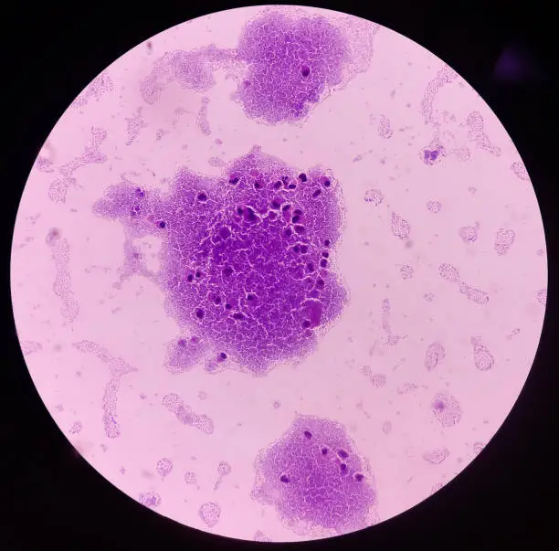 Photo of Photomicrograph of urine microscopy, urine cytology, Pap stain. Shows superficial squamous epithelial cells, neutrophils and occasional histiocytes.
