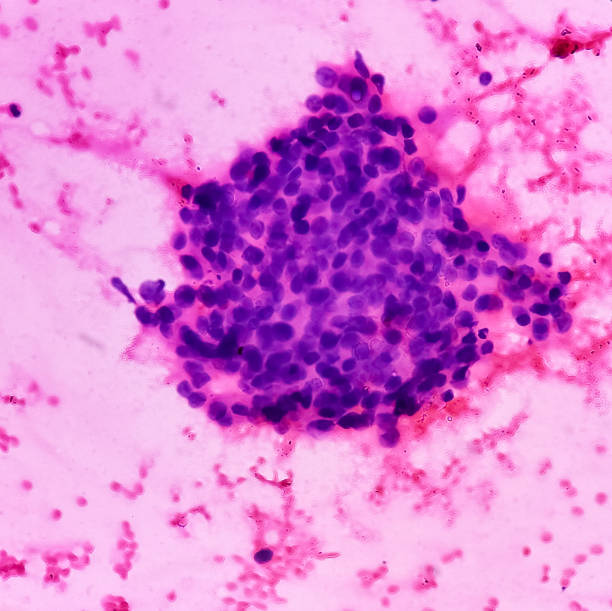bulka prsu (fna cytologie): proliferativní onemocnění prsu s atypií, zobrazení buněčného materiálu pozadí ukazuje krev. atypická hyperplazie. - gangréna - stock snímky, obrázky a fotky