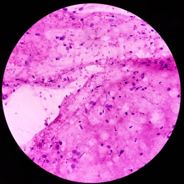 istock Neurofibromatosis. Neurofibroma (FNA Cytology), microscopic image show spindle shaped cells with wavy nuclei. Genetic disorders with formation of tumors in nervous system. 1465570472