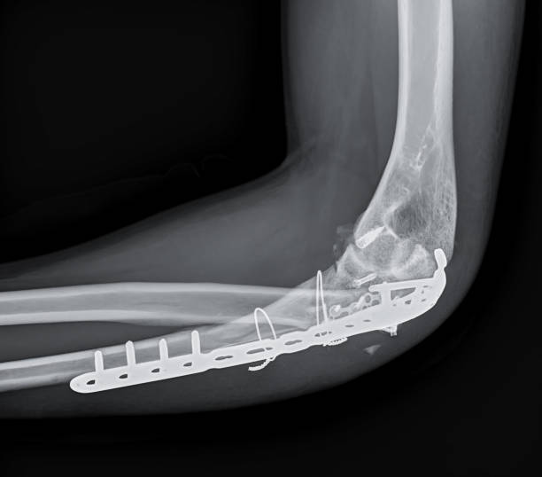 X-ray of  Elbow  showing internal fixation of the elbow joint. stock photo