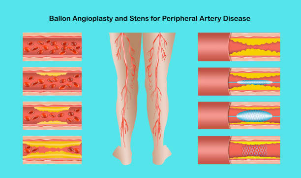 Diagram showing angioplasty for peripheral artery disease illustration Diagram showing angioplasty for peripheral artery disease illustration. Concept of dry skin, old senior people, varicose veins and DVT . clogged artery stock illustrations