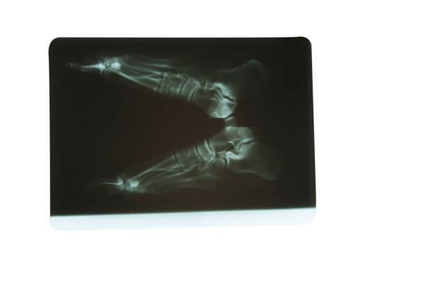 Film x-ray image of left toe front and oblique view for diagnosis Gouty arthritis.