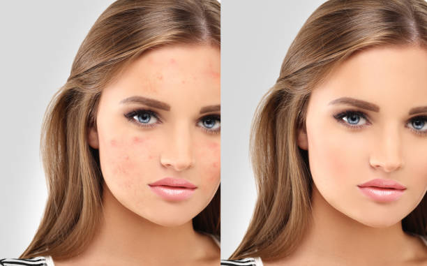 istock Post-Acne Marks .Treating Acne Scars.Acne Scar Removal 1465619936