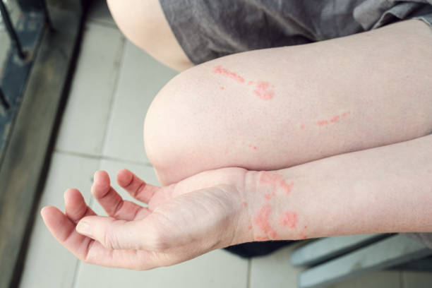 An allergic reaction on the skin from contact with a jellyfish Jellyfish bite marks on a woman's arm and leg. An allergic reaction on the skin from contact with a jellyfish. Red blisters on the skin. stinging stock pictures, royalty-free photos & images