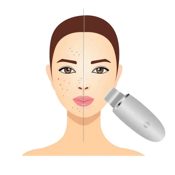 Vector illustration of Face cleaning, ultrasonic peeling, vector