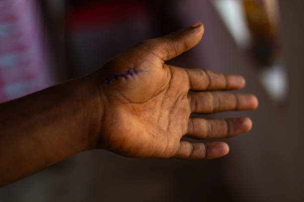 istock This is a human hand injured and the background behind the hand is blurred 1465992923