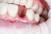 Woman showing mouth without broken tooth. Close up macro photo. Gap toothed