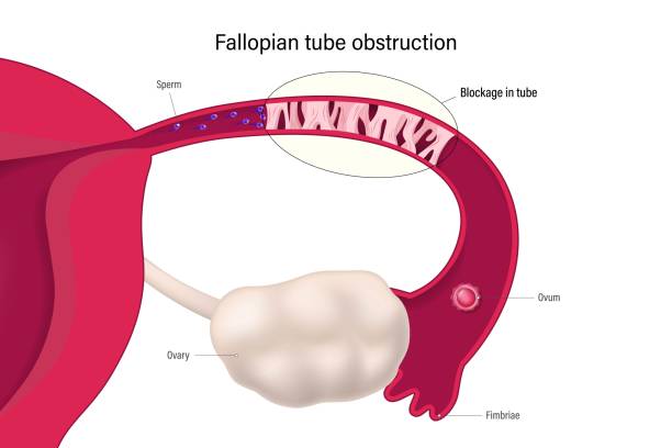 Fallopian tube obstruction. Block fallopian tube. Uterus and uterine tubes. Female reproductive system. Sperm cannot pass through and mix with the egg. Considered one of the causes of infertility. Fallopian tube obstruction. Block fallopian tube. Uterus and uterine tubes. Female reproductive system. Sperm cannot pass through and mix with the egg. Considered one of the causes of infertility. fallopian tube stock illustrations