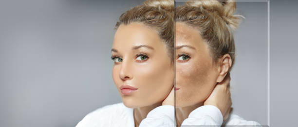 istock Dark spots, freckles,hyperpigmentation(melasma or chloasma),concept - skin lightening, skin whitening, fruit acids,AHA, Skin Brightening 1466324607