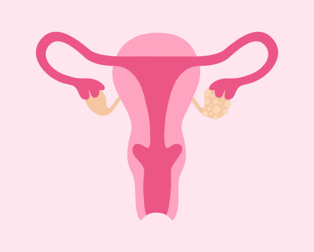 polyzystisches ovarialsyndrom. weibliches fortpflanzungssystem mit ovarialzysten - ovary stock-grafiken, -clipart, -cartoons und -symbole