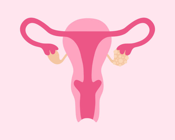 ilustrações de stock, clip art, desenhos animados e ícones de polycystic ovary syndrome. female reproductive system with ovarian cysts - ovary