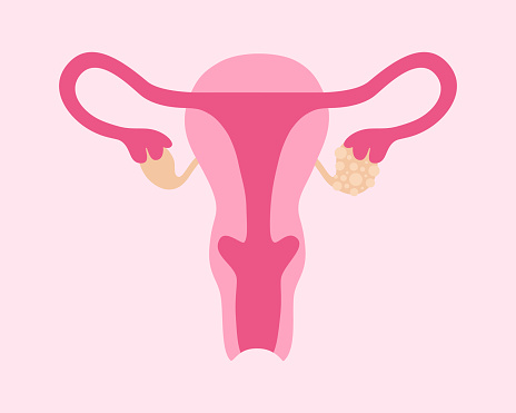 Polycystic Ovary Syndrome. Female Reproductive System With Ovarian Cysts