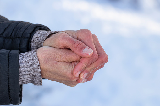 Women's frozen hands in the cold.Women's hands with dry skin and red fingers in the cold in winter.The concept of skin care in winter.