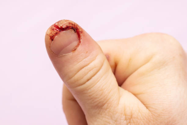 手指の身体的損傷。男性の指に血がついた新鮮な傷 - wound blood human finger physical injury ストックフォトと画像