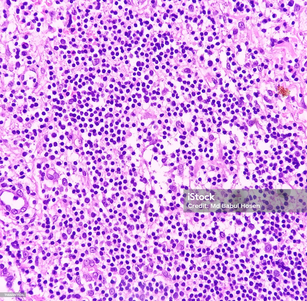 Perianal abscess tissue: Foreign body granuloma, microscopically show granuloma, cluster of epithelioid cells. - Royaltyfri Bangladesh Bildbanksbilder Perianal abscess tissue: Foreign body granuloma, microscopically show granuloma, cluster of epithelioid cells. - Royaltyfri Bangladesh Bildbanksbilder