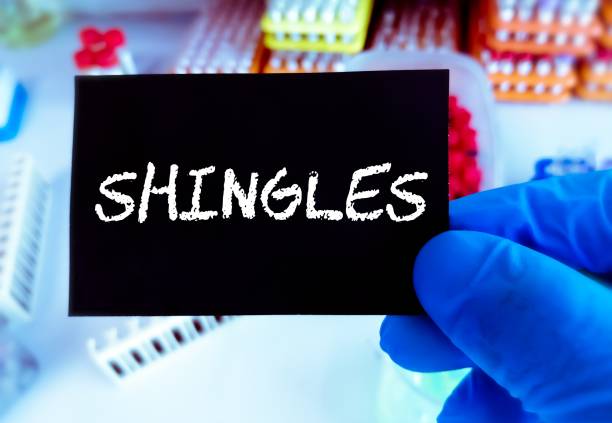 SHINGLES medical term. Medical conceptual image. SHINGLES medical term. Medical conceptual image. shingles rash stock pictures, royalty-free photos & images