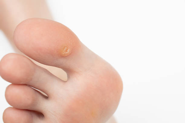 wart on the big toe. plantar wart on foot. foot with corns, calluses, verrucas. - sole of foot imagens e fotografias de stock