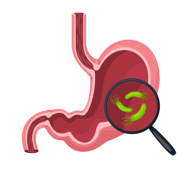 ilustraciones, imágenes clip art, dibujos animados e iconos de stock de estómago humano y helicobacter pylori. lupa con bacterias. - pylori