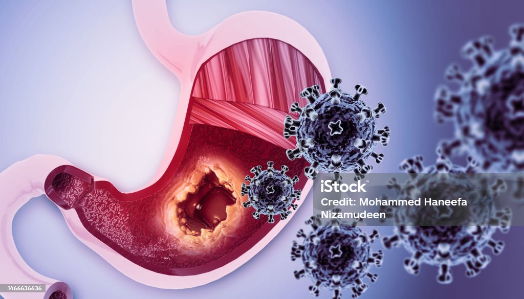 Stomach Cancer Gastric Cancer Symptoms Stages Treatment 3d Illustration ...