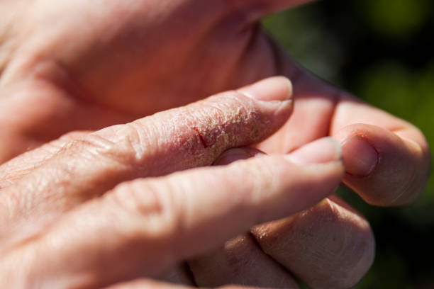 Palm of a young athlete with torn calluses, close-up. Concept of dedication, patience and diligence in sports.