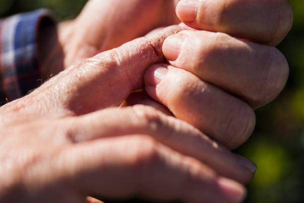 istock Itchy And Dry Hand Finger Skin With Health Problems 1466790142