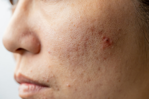 close up of asian woman with acne problem on her face