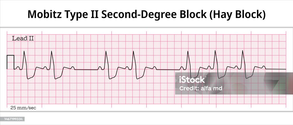 Subtle Mobitz Ii Hay Block Ecg Mobitz Type 2 Second Degree Atrioventricular Block 2nd ...