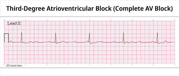 ilustrações, clipart, desenhos animados e ícones de ecg bloqueio atrioventricular de terceiro grau - bloqueio av completo - papel de ecg de 8 segundos - eletrocardiografia ilustração médica vetorial - sistema de condução cardíaco