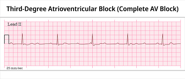 ECG Third Degree Atrioventricular Block - Complete AV Block - 8 Second ECG Paper - Electrocardiography Vector Medical Illustration