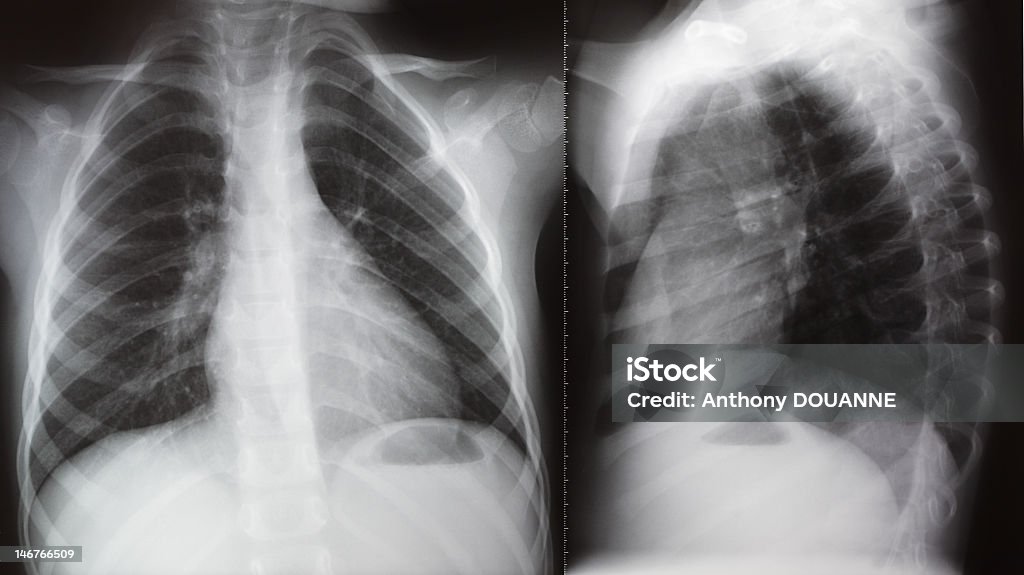 Tórax Xray pulmonar por radiación - Foto de stock de Bebé libre de derechos