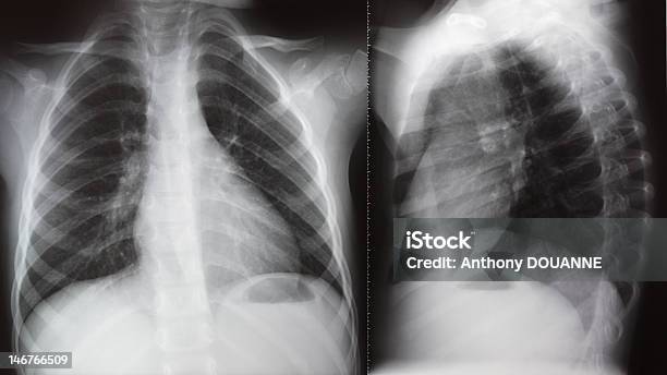 Polmone Radiazioni Radiografie Al Torace - Fotografie stock e altre immagini di Bebé - Bebé, Immagine a raggi X, Diaframma - Apparato respiratorio