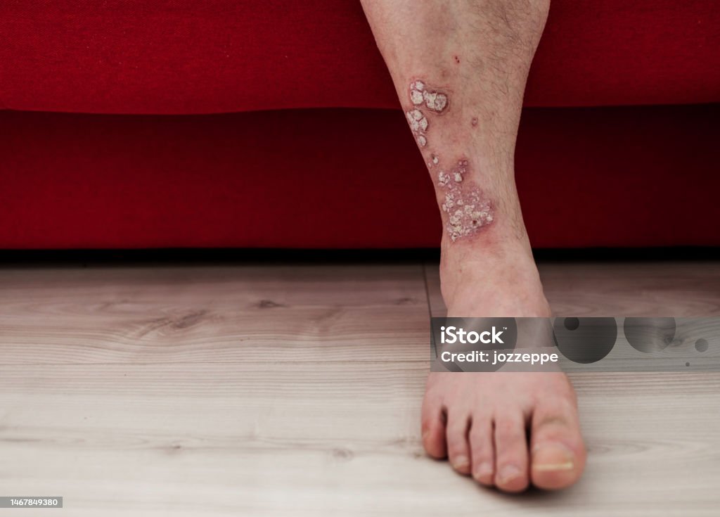 Dermatitis Problem Man With Dermatitis Problem Stock Photo - Download Image Now ...