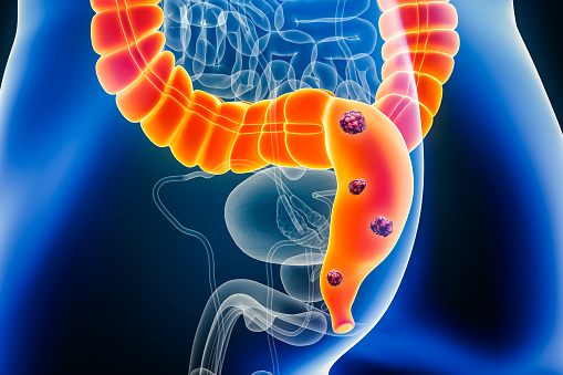 Rectum or colorectal cancer with organs and cancerous cells 3D rendering illustration with male body. Anatomy, oncology, bowels or intestinal disease, medical, biology, science, healthcare concepts.